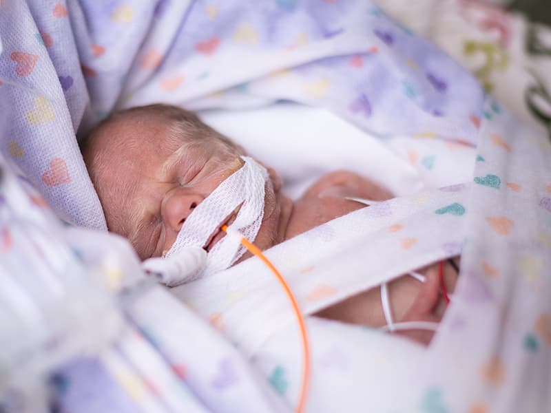 A premature infant with a feeding tube.