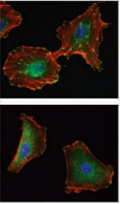 human lung cancer cells